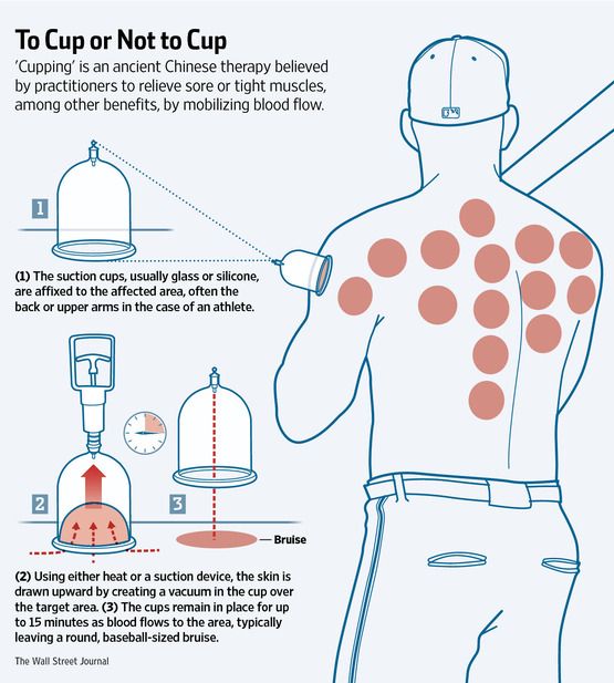 Cupping Signs